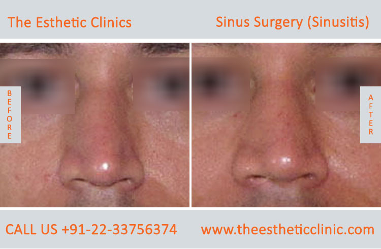 Sinus Surgery, Sinusitis before after photos in mumbai india (1)
